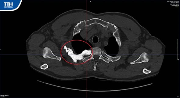 PHÁT HIỆN BỆNH NẾN XƯƠNG (MERLORHEOSTOSIS) BẰNG HỆ THỐNG CHỤP CẮT LỚP VI TÍNH CT SCANNER HIỆN ĐẠI TẠI TTH HÀ TĨNH