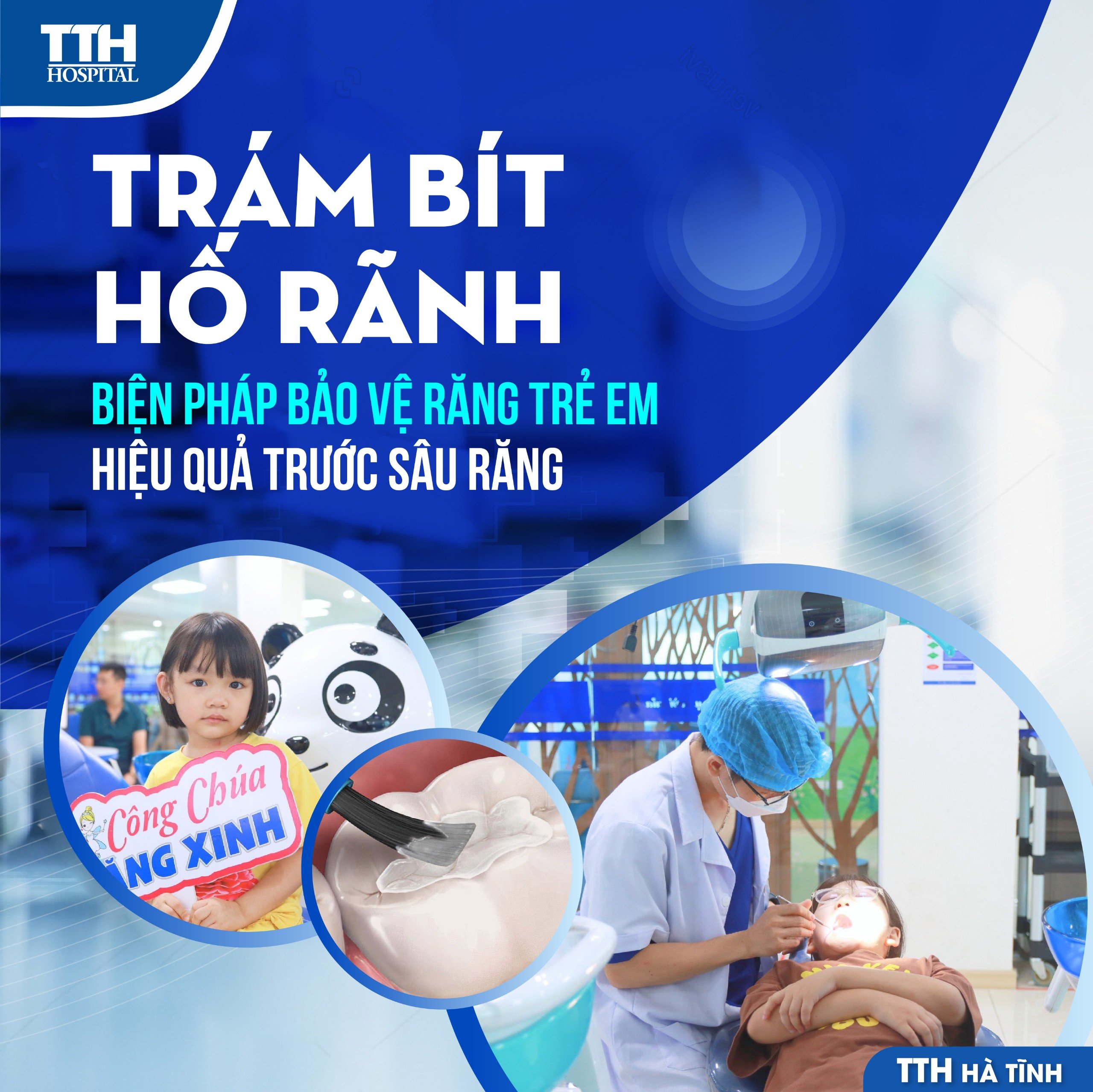 TRÁM BÍT HỐ RÃNH - BIỆN PHÁP BẢO VỆ RĂNG TRẺ EM HIỆU QUẢ TRƯỚC SÂU RĂNG