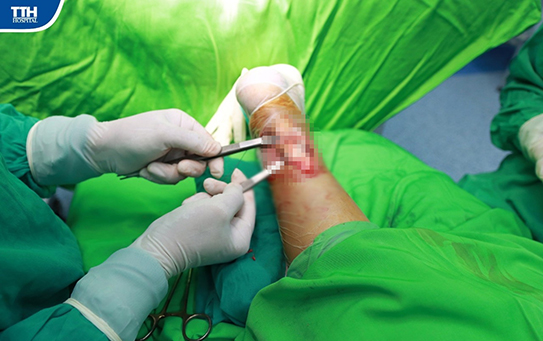 Cảnh báo đứt gân Achilles do chấn thương thể thao