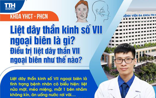 Liệt dây thần kinh số VII ngoại biên