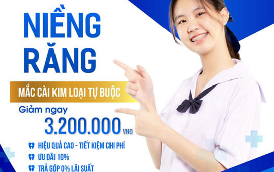 Niềng răng mắc cài kim loại tự buộc