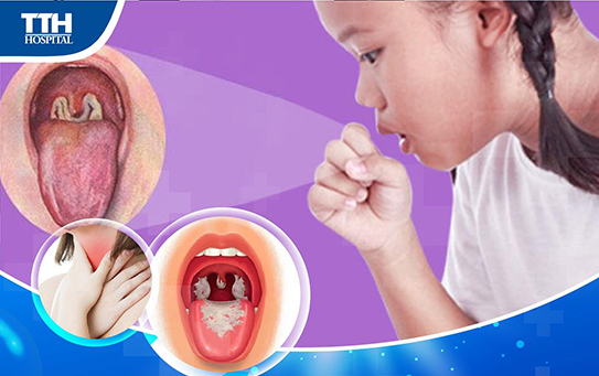 BỆNH BẠCH HẦU VÀ CÁC LƯU Ý KHÔNG NÊN BỎ QUA
