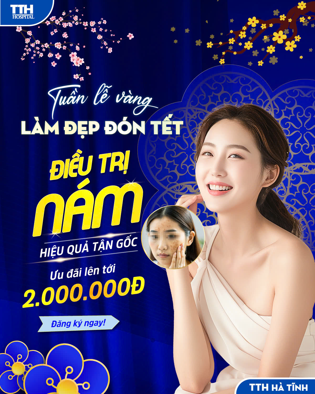 TUẦN LỄ VÀNG LÀM ĐẸP ĐÓN TẾT - ĐIỀU TRỊ NÁM HIỆU QUẢ TẬN GỐC