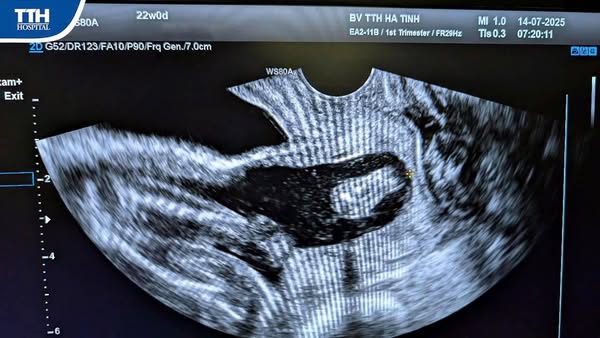 GIÀNH LẠI HY VỌNG TỪ RANH GIỚI SINH NON - CUỘC CHẠY ĐUA GIỮ SONG THAI 22 TUẦN