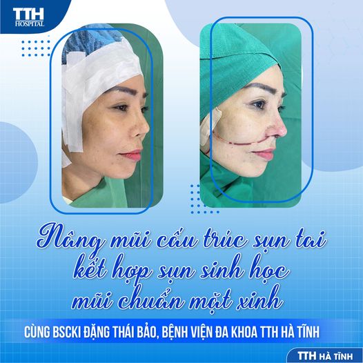 NÂNG MŨI CẤU TRÚC SỤN TAI KẾT HỢP SỤN SINH HỌC - MŨI CHUẨN MẶT XINH CÙNG BSCKI ĐẶNG THÁI BẢO
