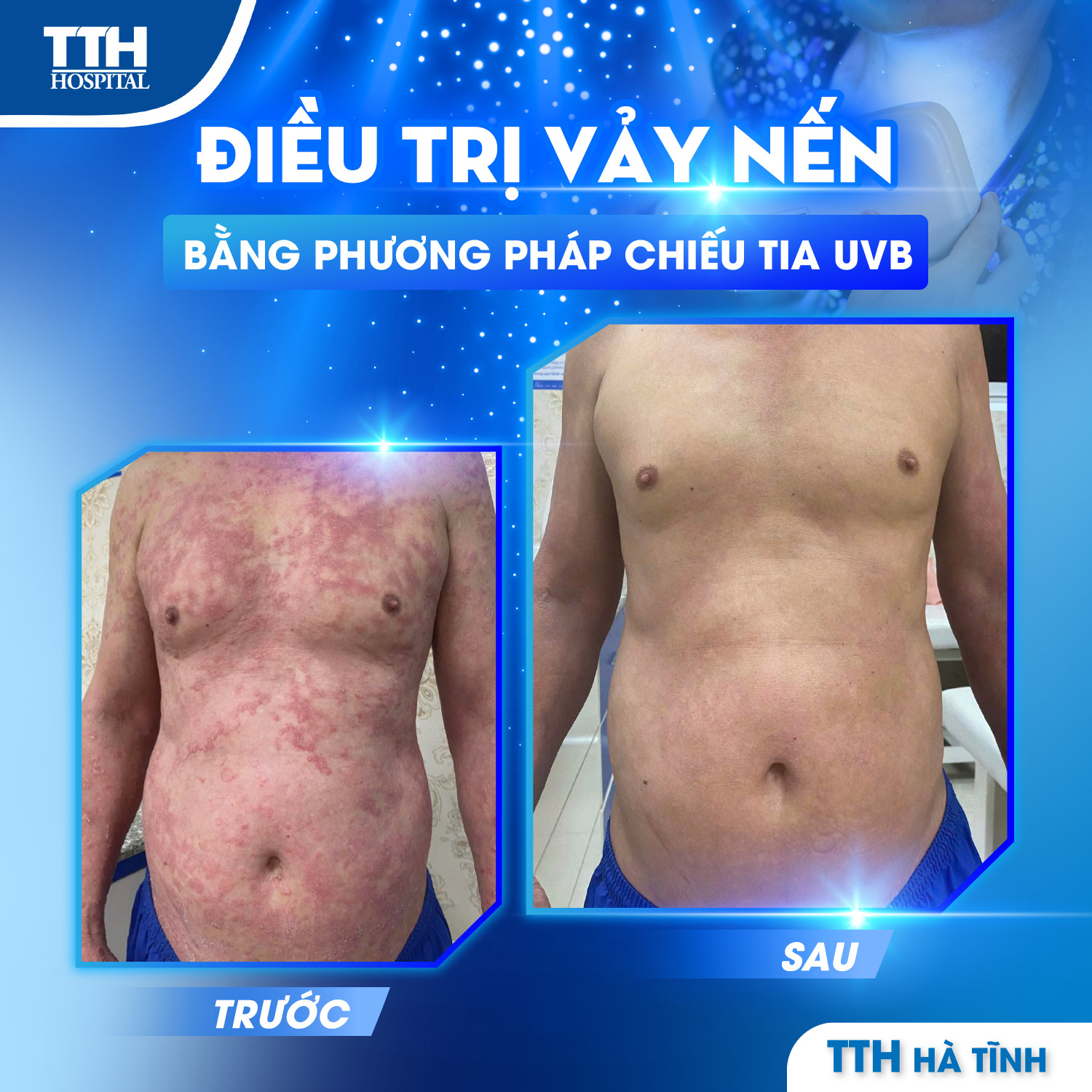 KẾT QUẢ ĐIỀU TRỊ VẢY NẾN BẰNG CHIẾU TIA UVB TẠI BỆNH VIỆN ĐA KHOA TTH HÀ TĨNH