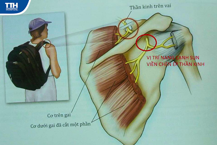 CHỤP CỘNG HƯỞNG TỪ CHẨN ĐOÁN VÀ PHÁT HIỆN RÁCH SỤN VIỀN KHỚP VAI