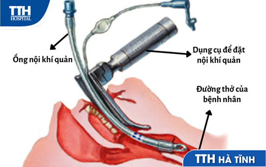 Đặt ống nội khí quản và những điều cần biết
