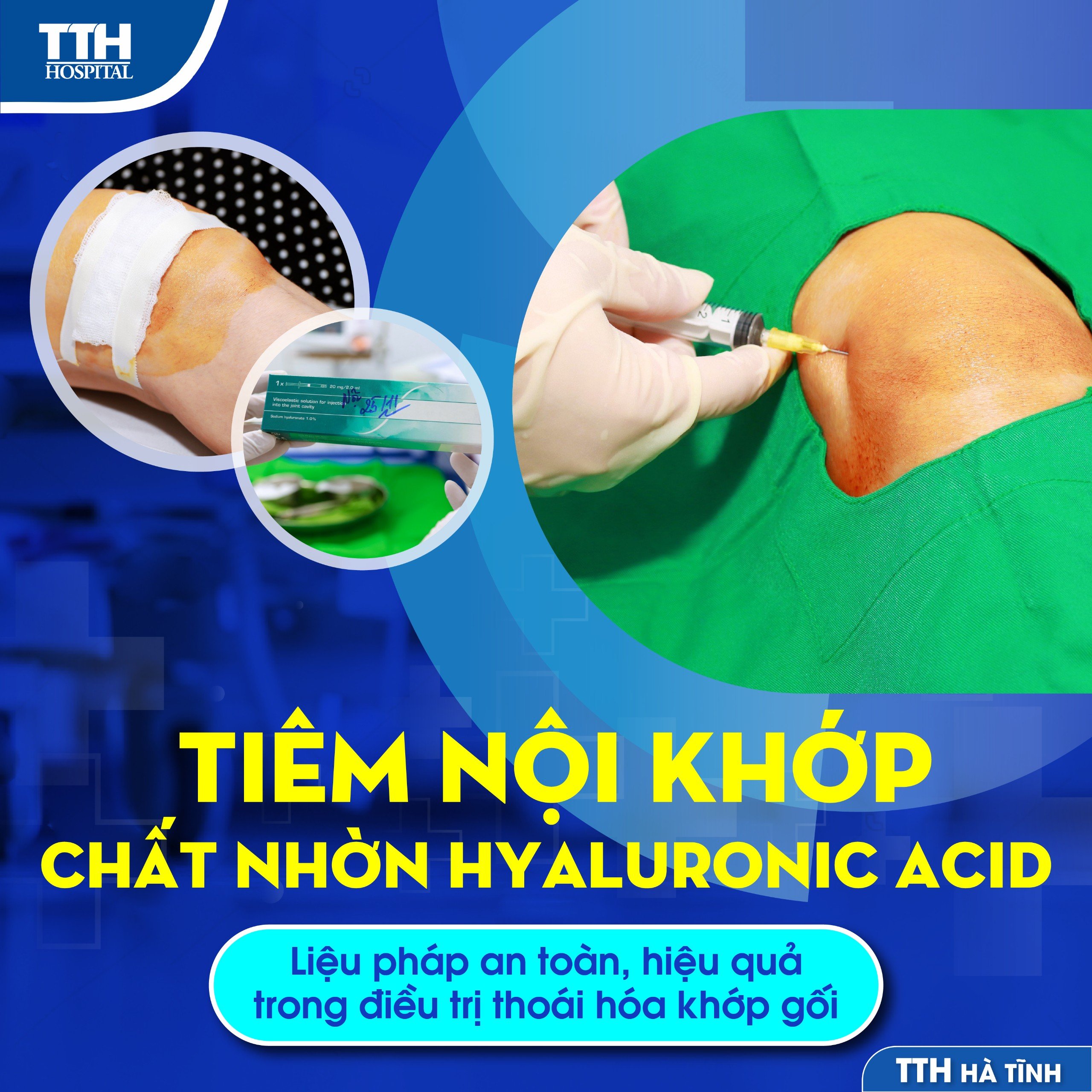 TIÊM NỘI KHỚP CHẤT NHỜN HYALURONIC ACID - LIỆU PHÁP AN TOÀN, HIỆU QUẢ TRONG ĐIỀU TRỊ THOÁI HÓA KHỚP GỐI